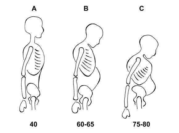 Osteoporose mit Isokinator-Training bekämpfen